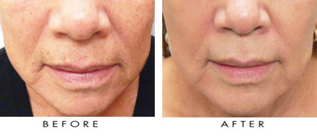 Remove facial veins south florida