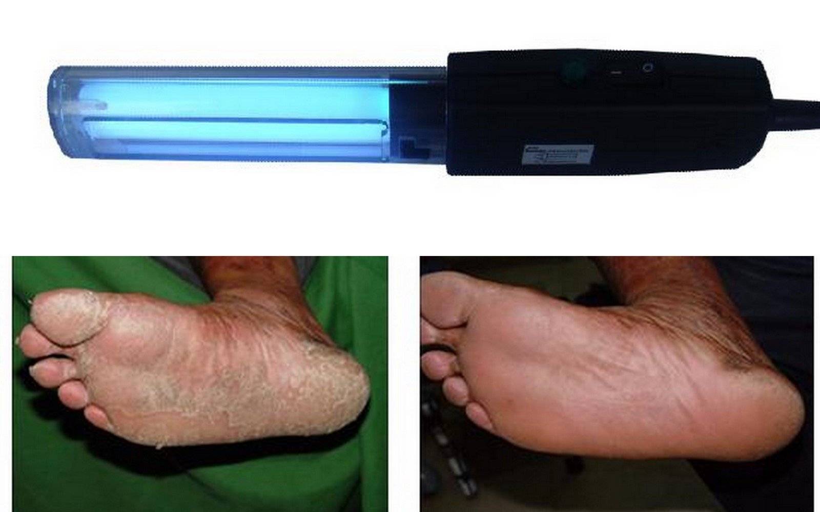 Psoriasis Treatment Hand-held Lamps - Derma Optic And Electronic ...